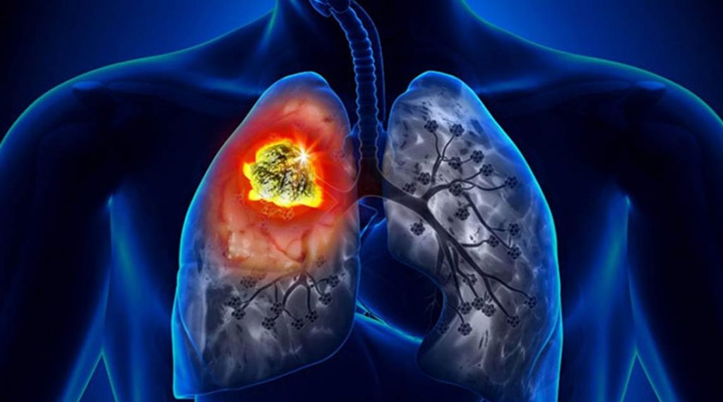 Tình trạng ung thư phổi